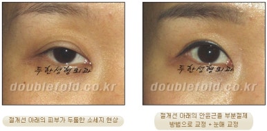 [Duhan Plastic Surgery Double Eyelid Revision Surgery] - [Ptosis, sausage eyelids] image 29