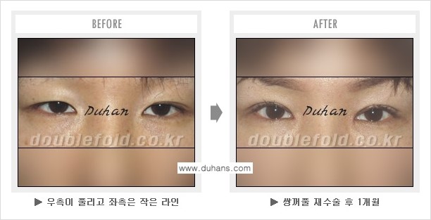 [두한성형외과 NO.1 쌍꺼풀 재수술] - [쌍꺼풀 재수술 - 푸는 수술을 하고 내원했을 경우의 문제] 관련 이미지 3