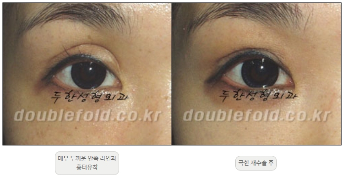 [Duhan Plastic Surgery Double Eyelid Revision] - [Thick Double Eyelid Line] image 41