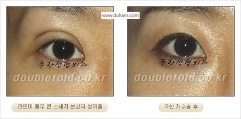 ​[두한성형외과 눈재수술] - [앞트임복원, 뒤트임복원, 쌍꺼풀복원] 관련 이미지 36