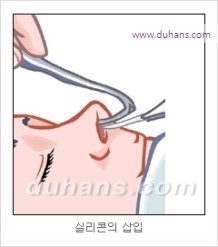 [두한성형외과 경쟁력 코성형 리더] - [자연스럽고 오똑한 콧망울! 코성형 방법]​ 관련 이미지 8