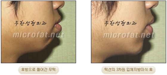 [두한성형외과 미세지방이식] - [무턱교정 안내] 관련 이미지 26