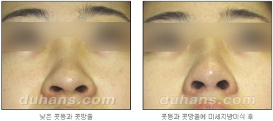 [두한성형외과 코재수술] - [코성형 안내] 관련 이미지 5