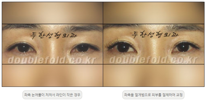 [두한성형외과 쌍커플재수술] - [비대칭 쌍커풀 라인] 관련 이미지 12