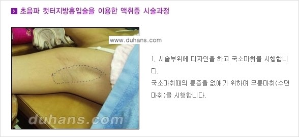 [두한성형외과 성형 FOCUS 지방흡입] - [액취증 - 다한증 초음파 컷터 지방흡입 ③] 관련 이미지 8