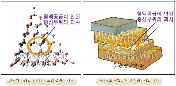 [Fat Grafting Duhan Plastic Surgery] - [Side Effects of Fat Grafting] image 5