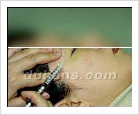 Duhan Plastic Surgery Wrinkle Improvement - Wrinkle Fillers, Juvederm image 9