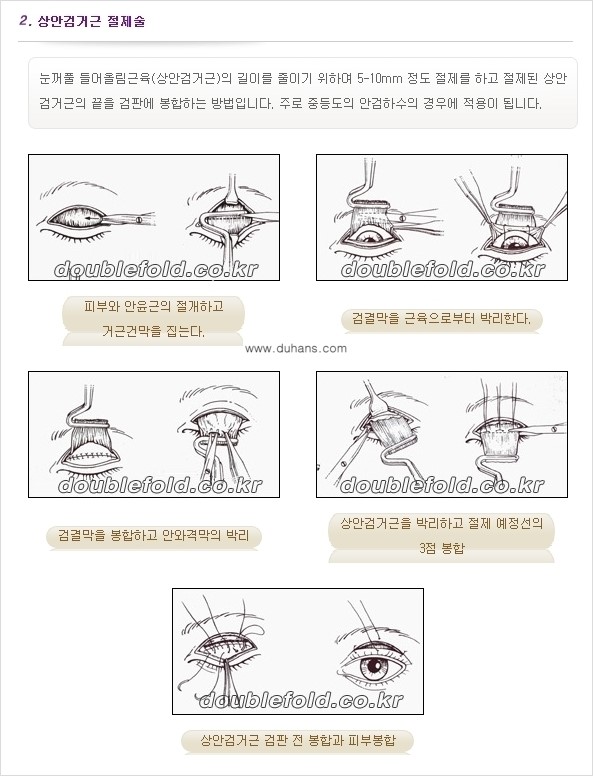 [두한성형외과 경쟁력 눈성형] - [안검하수(졸린 눈매) 재수술 안내 ②] 관련 이미지 8