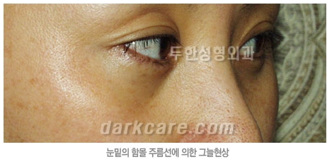 Duhan Plastic Surgery Dark Circle Improvement - What Causes Dark Circles? What Types of Dark Circles Are There? image 5