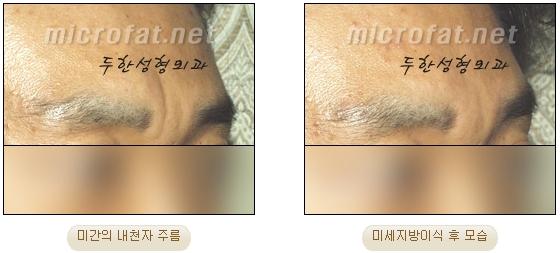 [두한성형외과 자가지방이식] - [미간주름] 관련 이미지 16