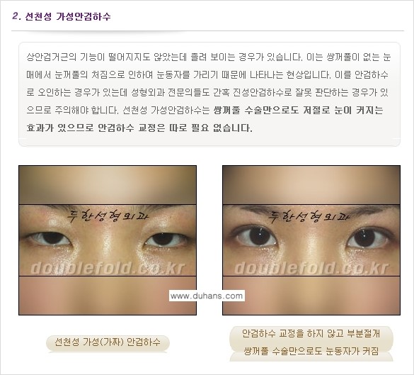 [두한성형외과 NO.1 "극한 눈(쌍꺼풀 재수술)"] - [안검하수(졸린눈매) 재수술 안내 1.] 관련 이미지 4