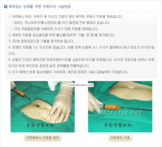 [두한성형외과 경쟁력 눈밑성형] - [눈밑 애교살 시술을 위한 미세지방이식] 관련 이미지 3