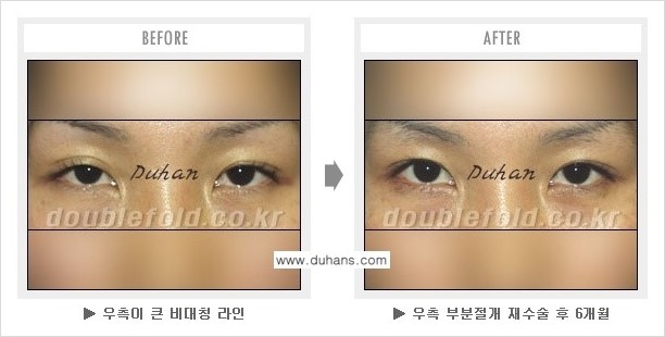 [두한성형외과 경쟁력 쌍꺼풀 재수술] - [과도한 앞트임이 되었을 경우 안내] 관련 이미지 2