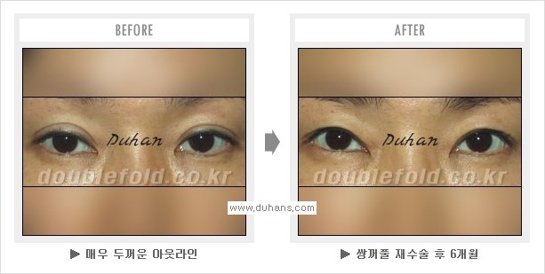 [두한성형외과 경쟁력 쌍꺼풀 재수술, 극한 눈재수술] - [망친 쌍꺼풀, 망가진 쌍꺼풀 복원수술, 재수술의 성공요건] 관련 이미지 9