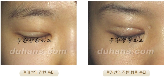 두한성형외과 눈재수술 - 쌍꺼풀 재수술 방법 관련 이미지 47