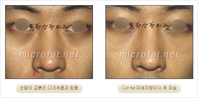 두한성형외과 눈밑수술 - 다크서클 수술 전후 관리 안내 관련 이미지 9