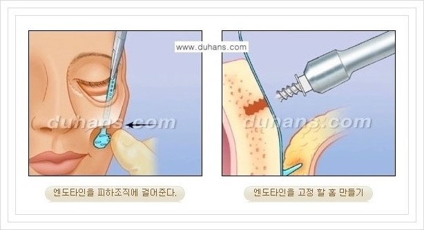 [두한성형외과 경쟁력 주름성형] - [눈썹거상, 앞볼처짐 개선의 엔도타인 리프팅] 관련 이미지 9