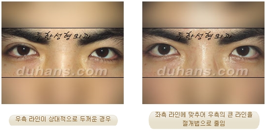두한성형외과 눈재수술 - 쌍꺼풀 재수술 방법 관련 이미지 13