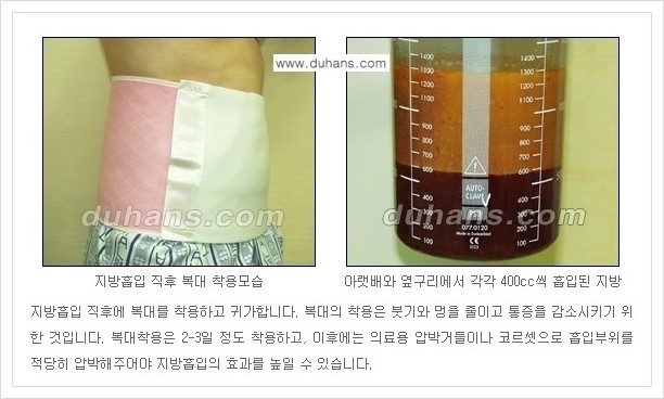 [두한성형외과 경쟁력 초음파 간편지방흡입] - [복부지방흡입, 허벅지지방흡입, 엉덩이지방흡입, 팔뚝지방흡입 안내] 관련 이미지 13
