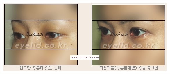 [두한성형외과 경쟁력 눈성형] - [퀵쌍꺼풀(부분절개법) 안내] 관련 이미지 10