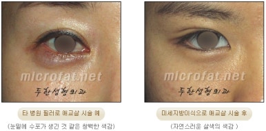 두한성형외과 눈밑성형 - 애교필러 후 눈밑재수술 관련 이미지 4