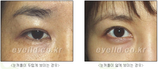 쌍커풀수술 두한성형외과 - 나에게 맞는 눈성형은? 관련 이미지 12