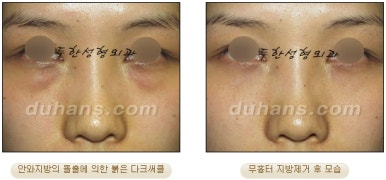 [두한성형외과 지방제거] - [눈두덩이지방제거, 눈밑지방제거] 관련 이미지 38