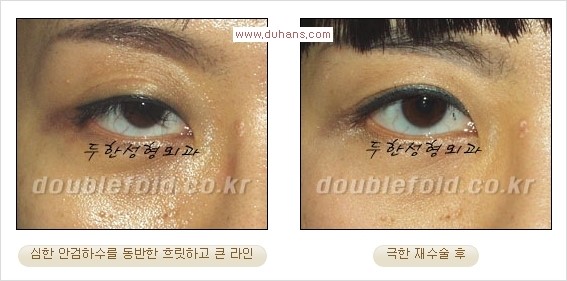 [두한성형외과 경쟁력 쌍꺼풀 재수술] - [피부 여유분이 부족해서 토안증이 발생한 경우 극한 재수술] 관련 이미지 5