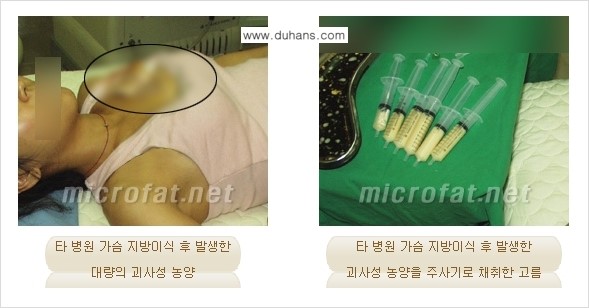 [두한성형외과] - [제대로 된 지방이식으로 부작용에서 탈출하자!] 관련 이미지 10