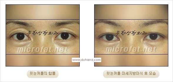 [두한성형외과 Dr. 컬럼] - [눈꺼풀의 지방이식] 관련 이미지 4
