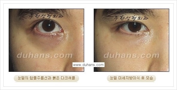 [두한성형외과 경쟁력 눈밑성형] - [꺼진 눈밑, 눈밑 함몰 주름선 눈밑 미세지방이식 안내] 관련 이미지 5