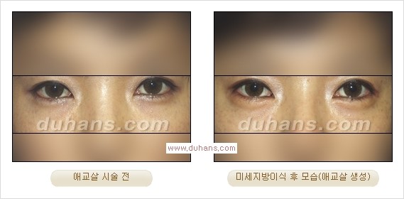 [두한성형외과 경쟁력 눈밑성형] - [눈밑애교살 시술을 위한 미세지방이식] 관련 이미지 17