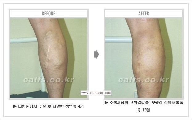 [두한성형외과 경쟁력 멀티종아리성형] - [종아리성형 방법별 전후 주의사항] 관련 이미지 40