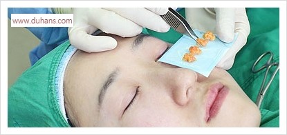 [두한성형외과 경쟁력 눈밑성형] - [다크써클 치료 전후 관리사항] 관련 이미지 4
