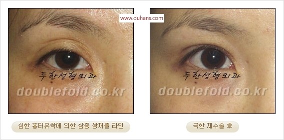 [두한성형외과 경쟁력 쌍꺼풀 재수술] - [두꺼운 라인을 교정하는 극한 재수술(Extreme Rroperation)] 관련 이미지 6