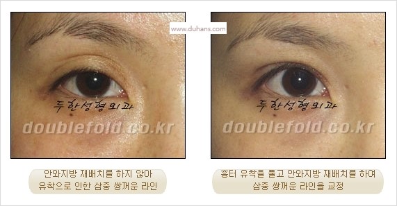[두한성형외과 경쟁력 눈성형] - [쌍꺼풀 재수술 실패의 원인과 문제점] 관련 이미지 5