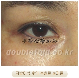 [두한성형외과 쌍수] - [재수술 실패의 원인, 재수술의 성공 요건] 관련 이미지 16