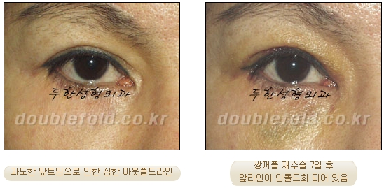 [두한성형외과 쌍커플 재수술] - [비절개눈매교정 재수술] 관련 이미지 4