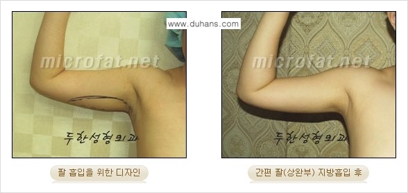 [두한성형외과 겨울엔 지방흡입] - [간편한 복부지방흡입 도전 2.] 관련 이미지 11
