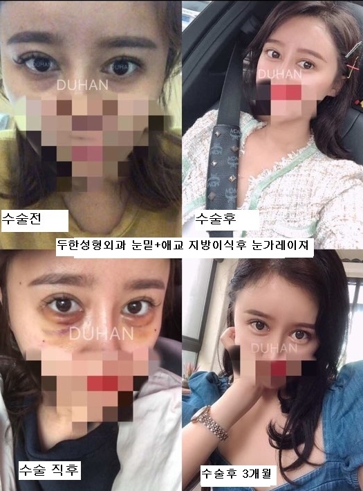 두한성형외과 - 눈밑레이저, 주름레이저, 레이저치료 ,눈밑주름,눈가주름, 눈주름, 잔주름, 깊은주름, 주름, 주름개선, 주름교정 관련 이미지 2