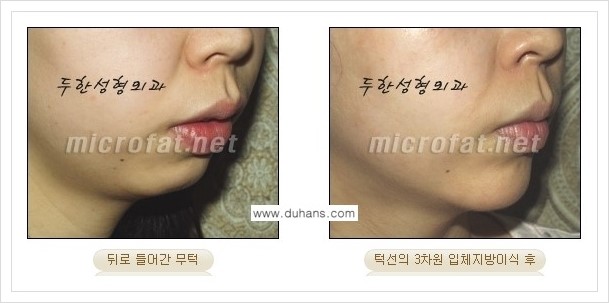 [두한성형외과 경쟁력 안면윤곽 교정] - [미세지방이식으로 무턱, 작은턱, 오목턱, 턱선의 비대칭 교정 안내] 관련 이미지 13