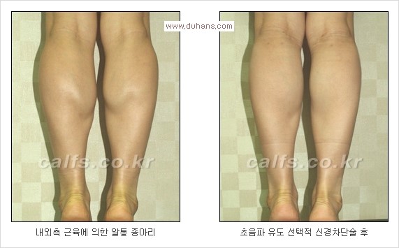 [두한성형외과 Dr. 컬럼] - [종아리 근육퇴축술로 가장 선호하는 비절개 초음파 유도 선택적 신경차단술] 관련 이미지 21