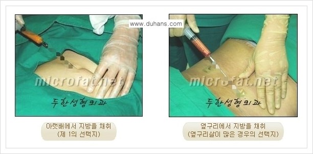 [두한성형외과 경쟁력 미세지방이식] - [두한 미세지방이식 클리닉의 특징 안내] 관련 이미지 4