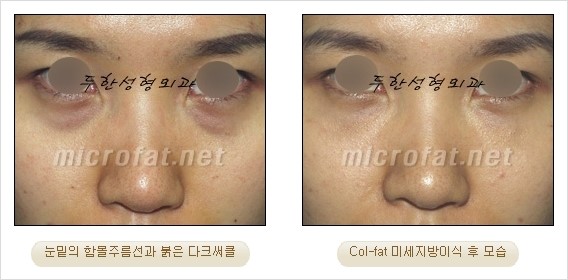 ​[두한성형외과 경쟁력 눈밑성형 리더] - [눈밑 다크써클의 증상, 원인, 종류, 치료방법 안내] 관련 이미지 44