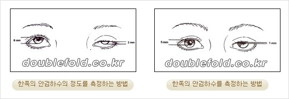 [두한성형외과 경쟁력 눈성형] - [극한 재수술, 함몰된 눈꺼풀 라인교정, 안검하수(졸리운 눈매)] 관련 이미지 90