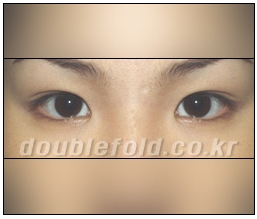 [Dohan Plastic Surgery Double Eyelid Surgery] - [Beautiful Double Eyelids] image 8