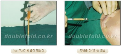 [DoubleFold Plastic Surgery Eye Surgery] - [Revision Surgery for Thick Double Eyelids] image 15