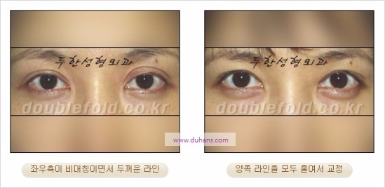 [두한성형외과 경쟁력 눈성형] - [비대칭 쌍꺼풀 라인의 여러 가지 교정 방법] 관련 이미지 15