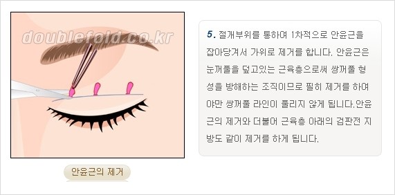 [두한성형외과 경쟁력 쌍꺼풀 재수술, 극한 재수술] - [쌍꺼풀 재수술의 과정 안내 2.] 관련 이미지 8
