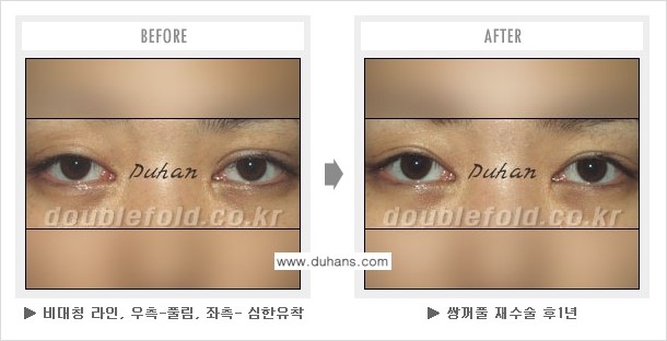 [두한성형외과 쌍꺼풀 재수술] - [여러번의 쌍꺼풀 재수술로 인한 흉살이 두터운 경우의 문제] 관련 이미지 4